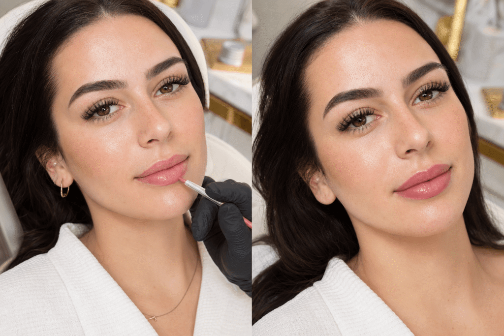 can i do lip blush after lip filler